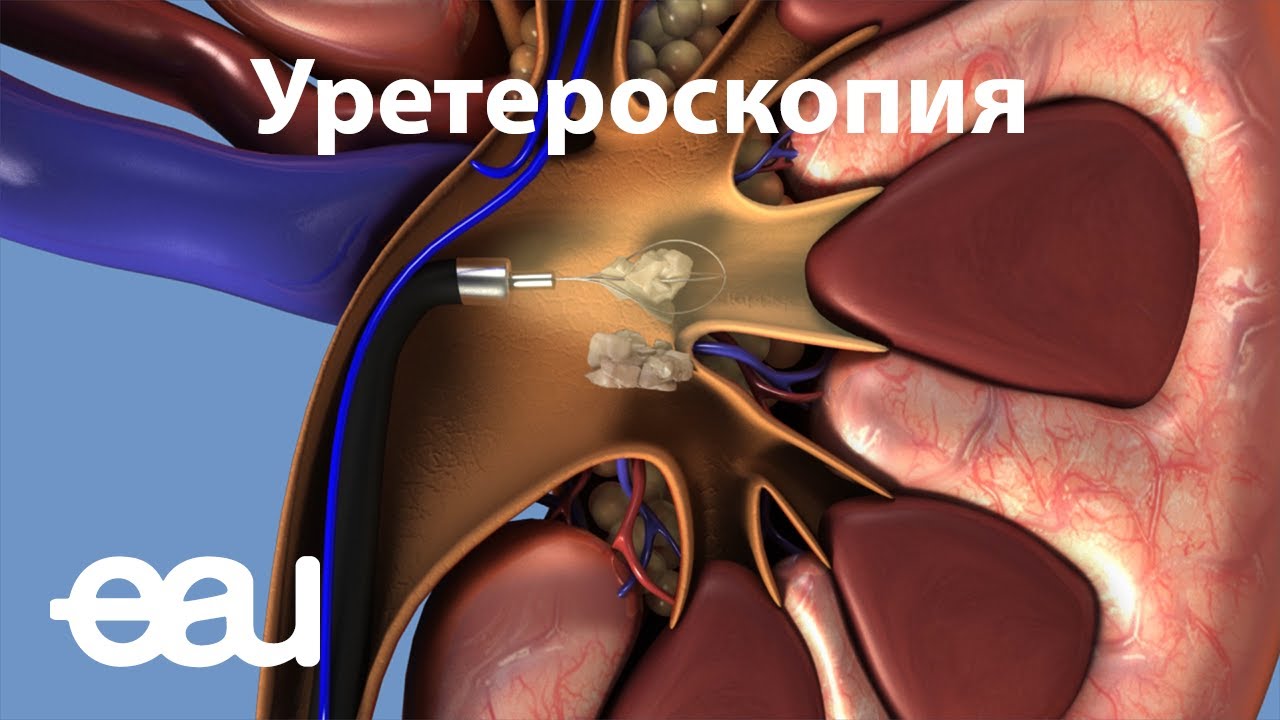 где дробятся камни в почках?