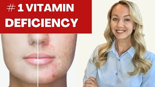 The Top Vitamin Deficiency With Acne