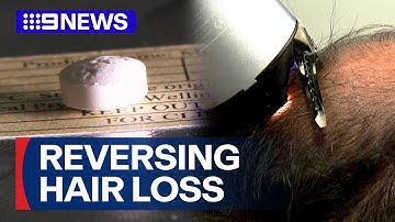 Volunteers wanted for hair-loss transformation clinical trial | 9 News Australia