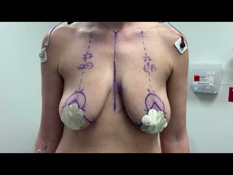 Breast Lift without Implants by Dr. Youn- Before and After