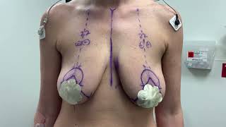 Breast Lift without Implants by Dr. Youn- Before and After
