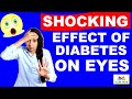 Shocking Effect Of Diabetes On Eye Cataract | Sorbitol Pathway In Diabetes | Daily MED