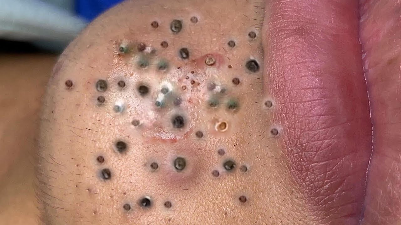 𝐂𝐫𝐚𝐳𝐲 𝐒𝐚𝐭𝐢𝐬𝐟𝐲𝐢𝐧𝐠 𝐁𝐥𝐚𝐜𝐤𝐡𝐞𝐚𝐝 𝐑𝐞𝐦𝐨𝐯𝐚𝐥 