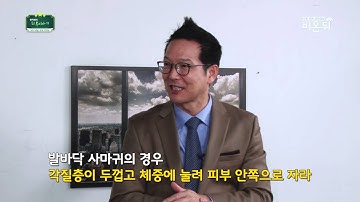 [함익병 피부 이야기] 사마귀 뿌리 뽑는 사마귀 제거 치료 방법 - 건강 정보 의학 채널 비온뒤