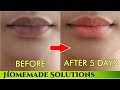 काले होंठो  प्राक्रतिक गुलाबी बनाने के नुस्खे | Remove darkness from lips get pink lips