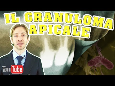 Video: Granuloma: Tipi, Cause, Trattamento, Origine