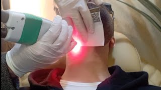 جهاز كانديلا لإزالة الشعر و تحديد اللحيه بالليزر للرجال#اول جلسه# Laser hair removal