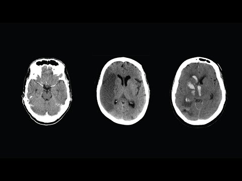 Video: Kranial CT-scanning: Formål, Procedure Og Forholdsregler