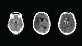 How to Read a CT Scan of the Head  MEDZCOOL