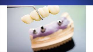 Salvatore Dental Implants in Ballston Spa, NY | 518-254-6062