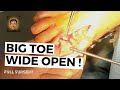 GRAPHIC OPENING OF TOE JOINT !  Great toe joint deformity / bunion surgery