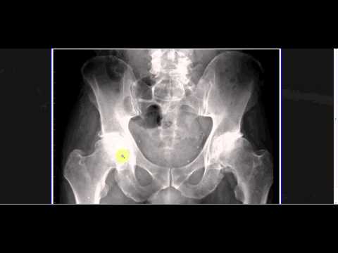 Interpreting X-Rays of the Pelvis, Hip Joint and Femur