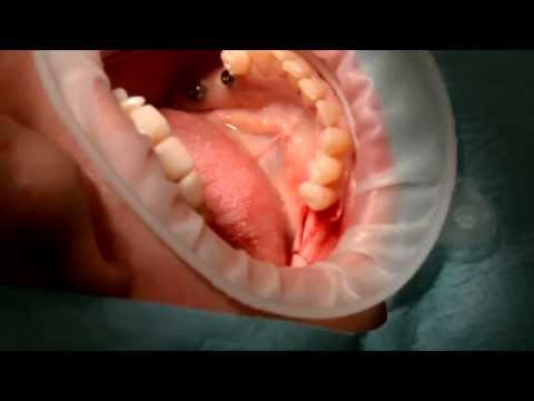 Dantų implantai - implantavimo procedūra