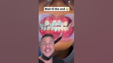 Thumbnail of How Braces Are Put On