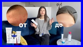 КАК Я ИЗБАВИЛАСЬ ОТ ПРЫЩЕЙ | вылечить ACNE | ZO SKIN by Zien Obagi