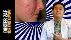 PENYEBAB JERAWAT DI PIPI - Inilah Penyebab Jerawat di Pipimu dan Cara Menghilangkannya - Durasi: 7.29. 