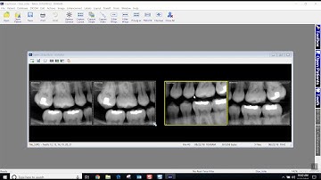 Training: Apteryx XrayVision 4: Acquiring 4 Bitewings