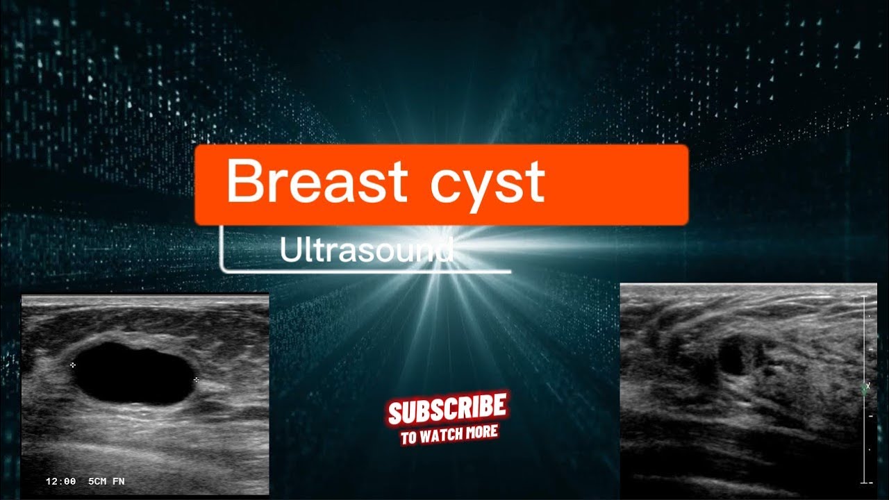 Breast cyst ultrasound, Echography Breast cyst, Echogaphie Kyste