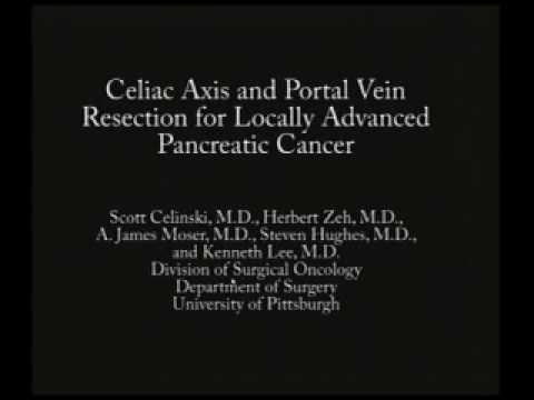 CELIAC AXIS AND PORTAL VEIN RESECTION FOR LOCALLY ADVANCED.w