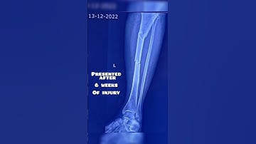 Six weeks Old Segmental tibia fracture treated with close tibia nailing till fracture healing.