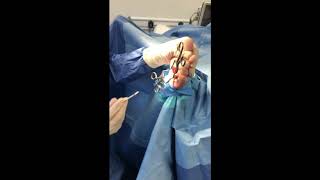 Dr  Nelson Removes a Stump Neuroma