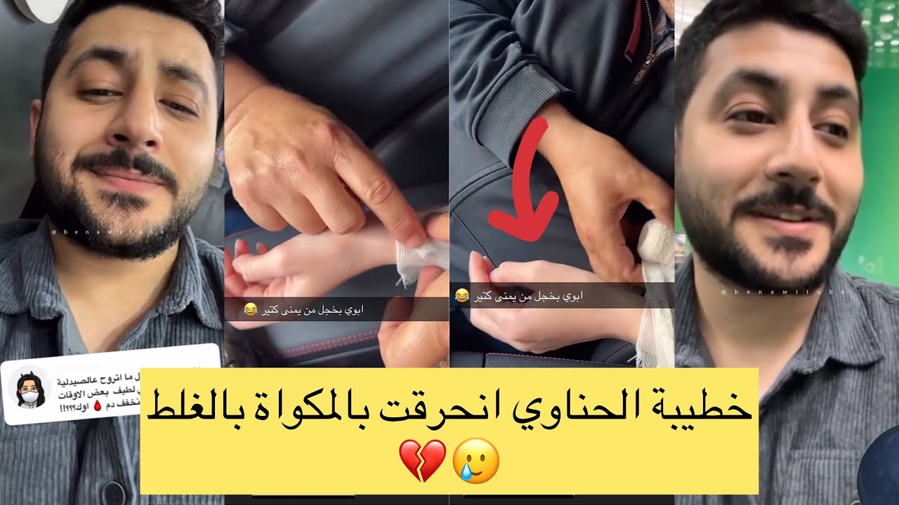 خطيبة الحناوي انحرقت بالمكواة بالغلط 🥲💔