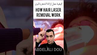 كيفية عمل إزالة الشعر بالليزر ?How hair laser removal work