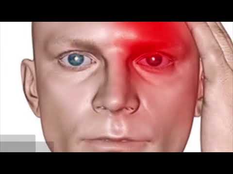 Dr. Walid Albanna Migraine الصداع النصفي الشقيقة ألم الرأس