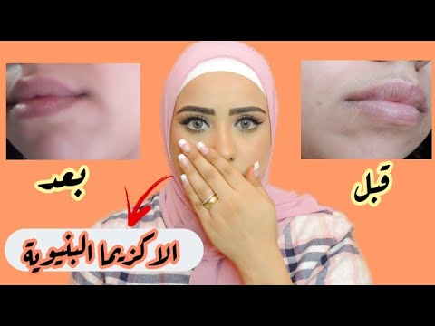 تجربتي مع علاج الاكزيما المسببة لإسمرار و سواد ما حول الفم 🌚