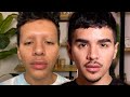 I Got An EYEBROW TRANSPLANT | Gabriel Zamora