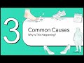 Foot pain? Think Plantar Fasciitis