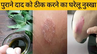 पुराने से पुराने दाद को ठीक करने का घरेलू उपाय | दाद खुजली को कैसे दूर करे |Home remedy for dad |