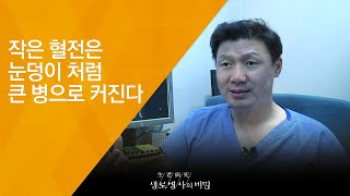 작은 혈전은 눈덩이 처럼 큰 병으로 커진다 - (20180829_660회 방송) 내 다리가 아픈 이유, 종아리를 주목하라