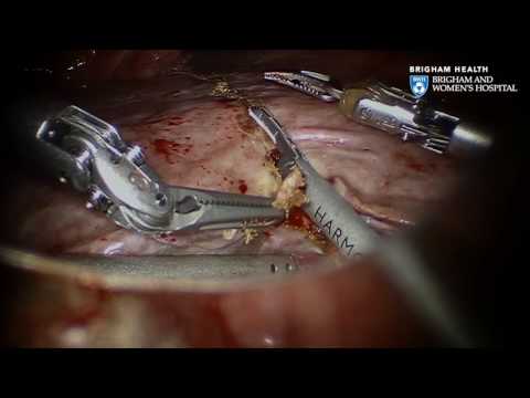 Liver Cancer: Robotic Hepatectomy Video - Brigham and Women's Hospital