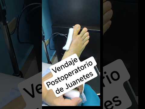Vendaje Postoperatorio de cirugía de Hallux Valgus con técnica MICA,