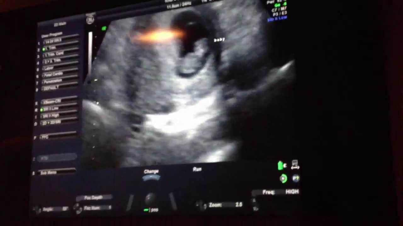 8 Week Ultrasound with Heartbeat - YouTube
