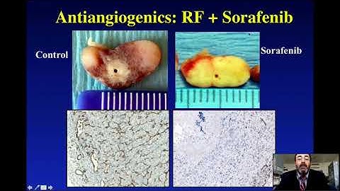 CCMA & SIO Webinar - Prof. Nahum Goldberg: Combination Therapies in Interventional Oncology
