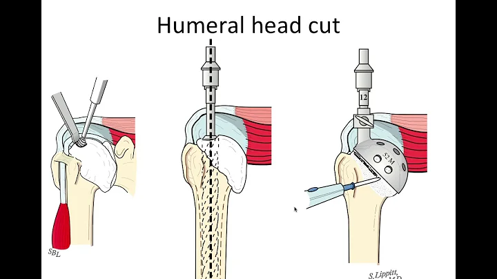 Ream and run shoulder replacement - What you need ...