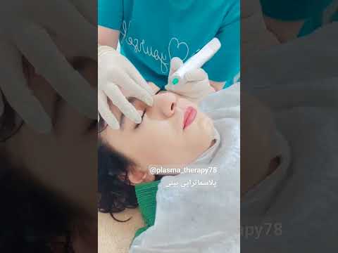 لیفت و کوچک کردن بینی پلاسماجت بینی لیفت بینی کوچک کردن بینی پلاسماجت بینی بینی فانتزی پلاسما