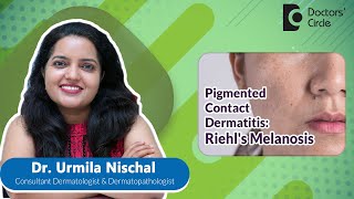 PIGMENTED CONTACT DERMATITIS |RIEHL MELANOSIS #skinproblems  - Dr. Urmila Nischal |Doctors' Circle