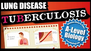 Lung Diseases | TB - Tuberculosis | A Level Biology Revision Notes