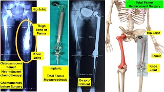 Total Femur Replacement with a Megaprosthesis or Artificial Joint: Key Animation steps