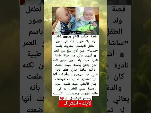 صورة مؤثرة وحزينة قصة حدثت العام 2019 لطفل ولد بلا عيون هذه هي صور الطفل المبتسم