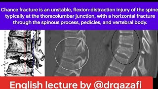 Chance fracture is an unstable,(English lecture) flexion-distraction injury, management and outcome