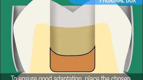 3M ESPE ● Posterior Restorations — Multi-Shade Technique