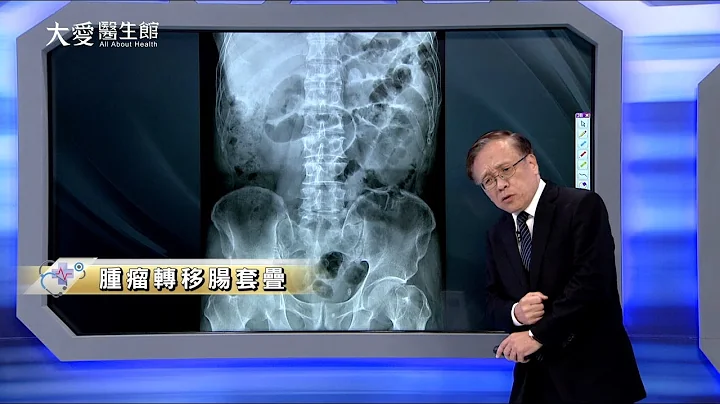 【大爱医生馆】肿瘤转移肠套叠 20240104 - 天天要闻