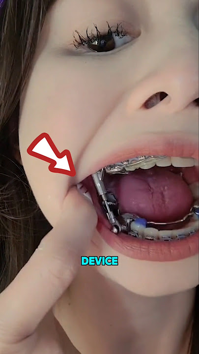 Genius Appliance for Straight Teeth