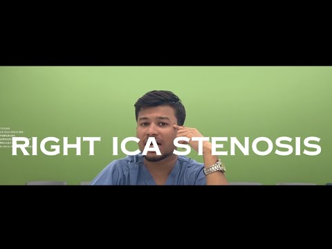 When a Carotid Stent Fails: The Mystery of Restenosis