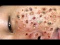 Loan nguyen acne treatment 14388