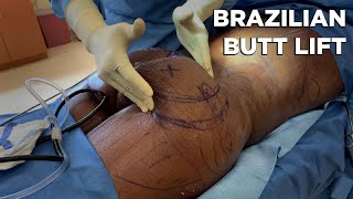 Brazilian Butt Lift - Dr. Michael Jones | Lexington Plastic Surgeons